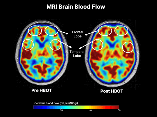 Hyperbaric oxygen treatment improve cognitive decline