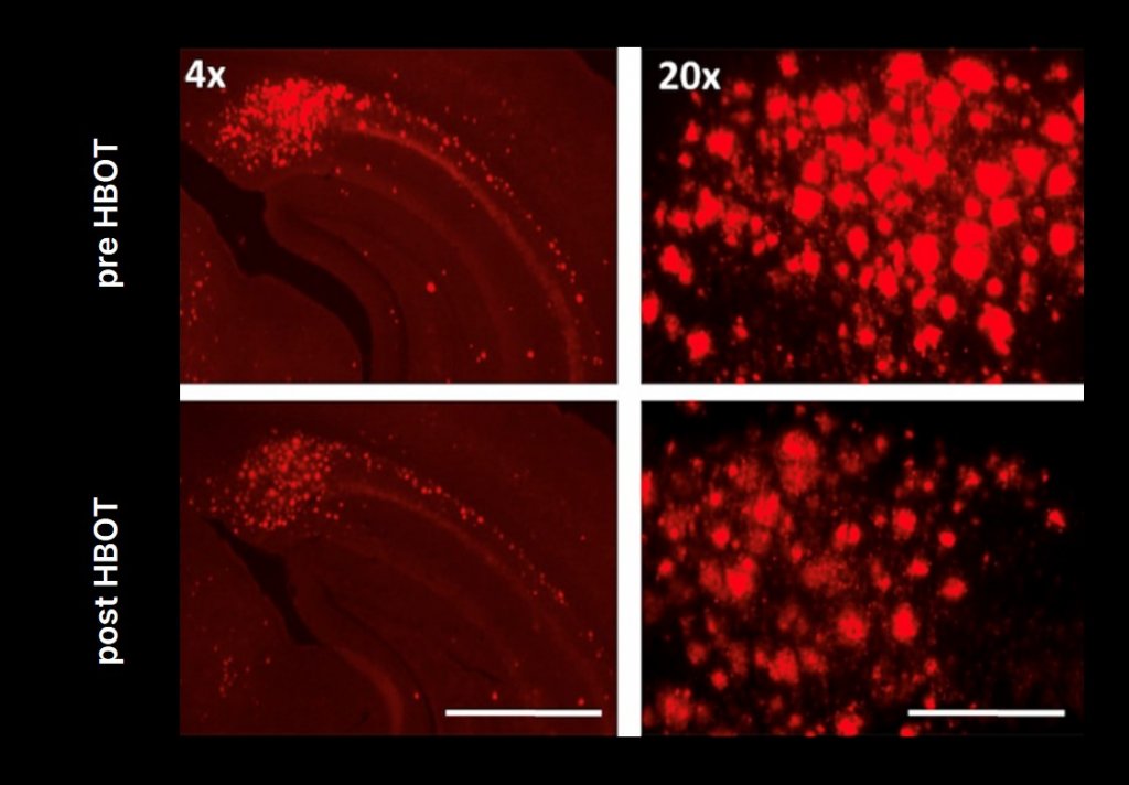 Alzheimer's treatment study - Reduced amyloid plaques resulting from hyperbaric oxygen therapy