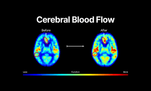 New Study Shows HBOT Can Reverse the Main Activators of Alzheimer’s Disease and Help Prevent Memory Loss