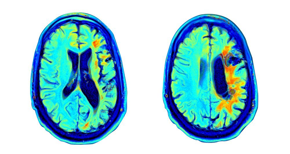 post-stroke-recovery