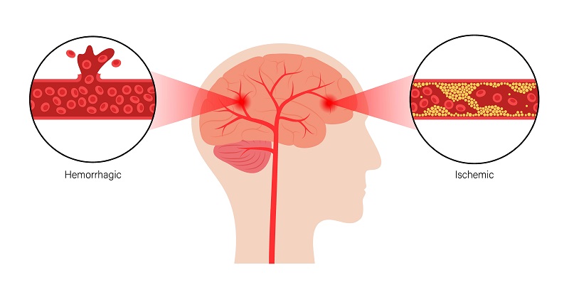 ischemic-stroke