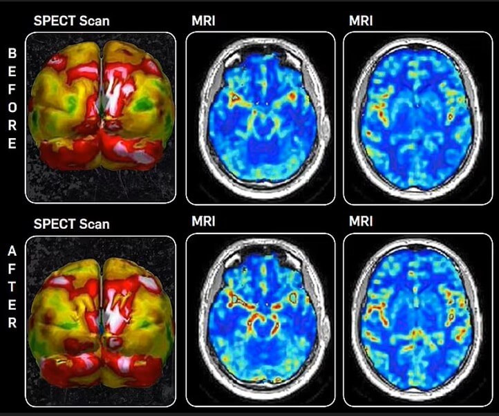 Dylan-Hartly-brain-scan